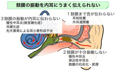 騒音性難聴、加齢性難聴、先天性難聴