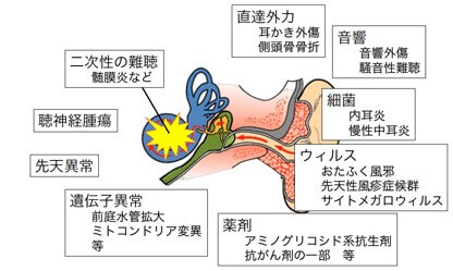 騒音性難聴、加齢性難聴、先天性難聴