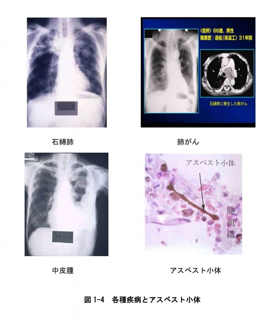 図
1 4 各種疾病とアスベスト小体