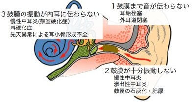 伝音難聴